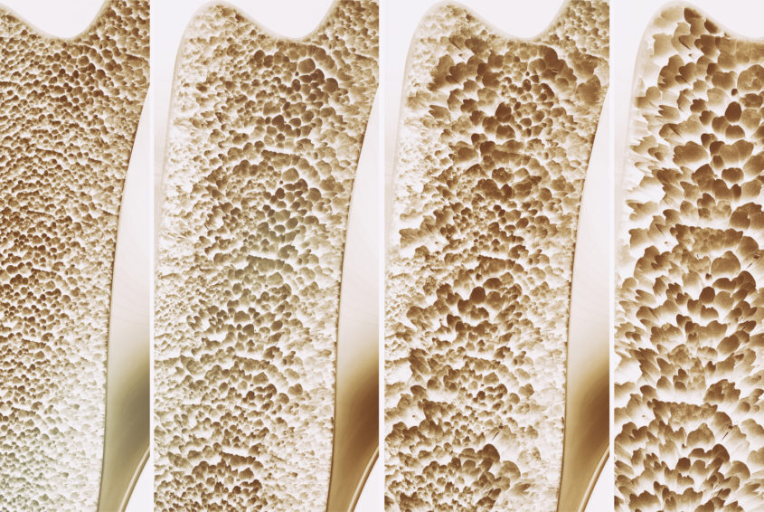 Osteoporosis 4 stages - 3d rendering