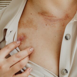 Usuwanie blizn laserem