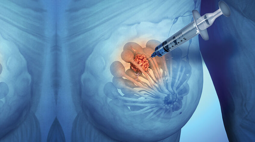 Diagnostyka piersi_02 diagnostyka piersi