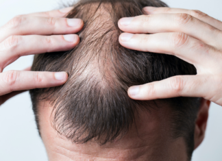 Łysienie bliznowaciejące