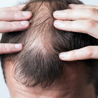 Łysienie bliznowaciejące