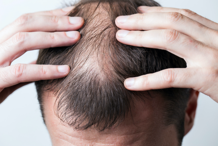 AdobeStock_442696452 Łysienie bliznowaciejące