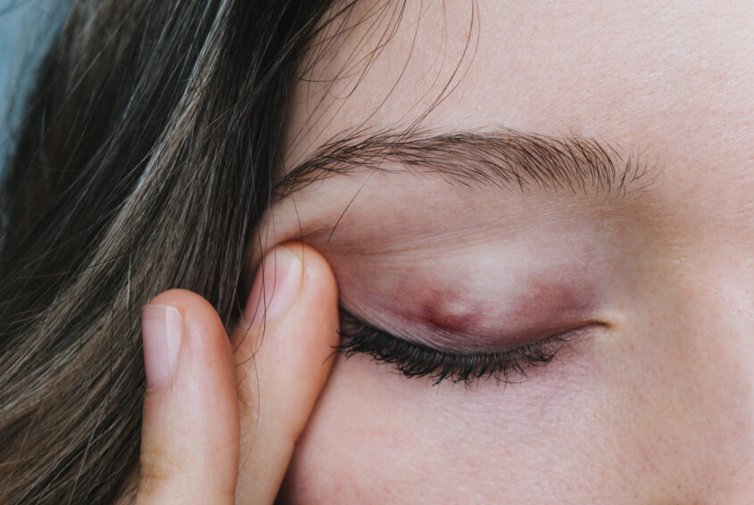 young girl shows a chalazion on the eyelid closeup gradówka